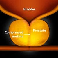 Educational diagram of the male urinary system featuring the bladder, prostate, and compressed urethra in warm orange tones – resource for UroLift treatment insights.